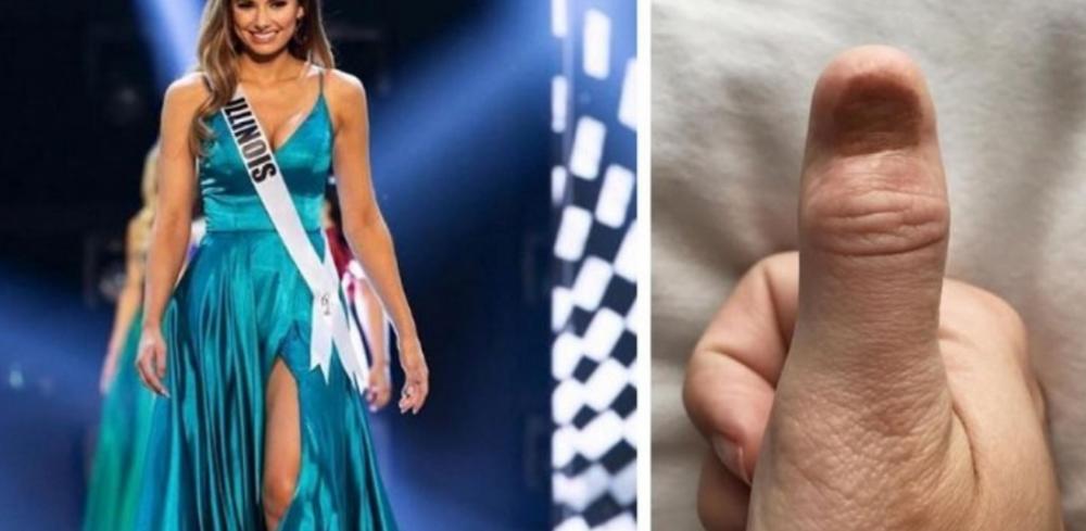 Ex-miss desenvolve câncer raro após uso excessivo de unhas em gel