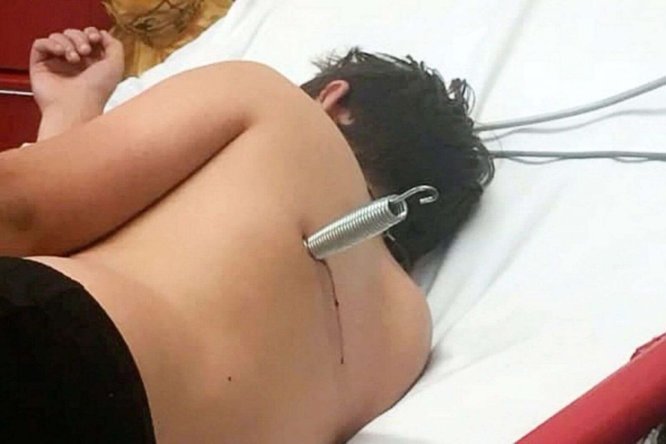 Criança sofre acidente em pula-pula e fica com mola cravada nas costas