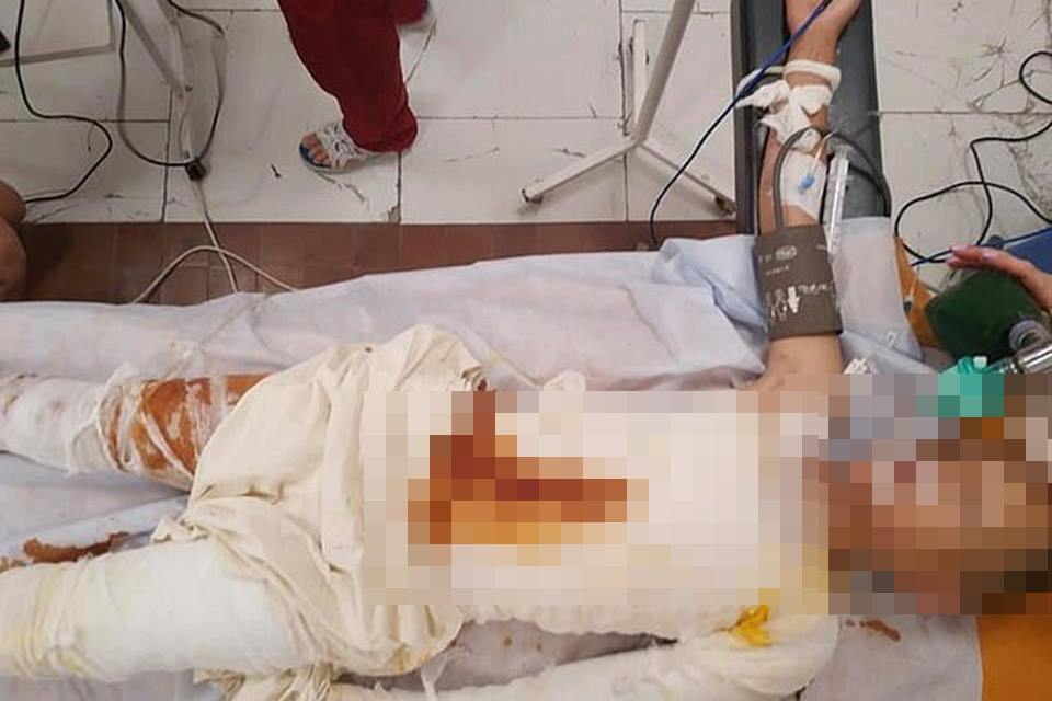 Adolescentes ateiam fogo em menino de 8 anos por pura maldade