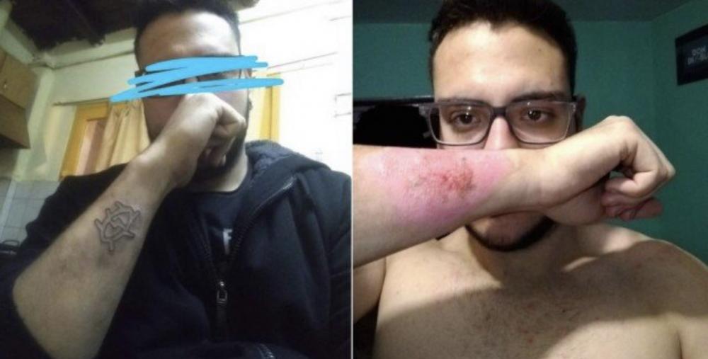 Homem usa ralador de queijo para remover tatuagem