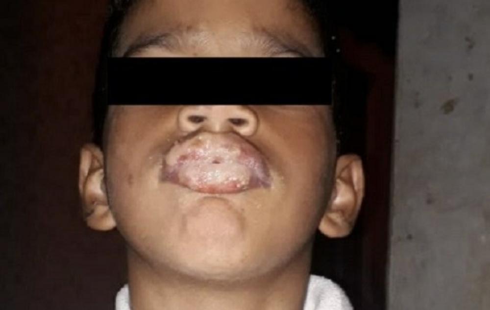 Criança tem a boca queimada pela própria mãe