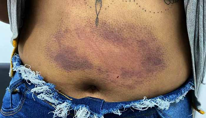 Agredida com barras de ferro, mulher passa 17 dias sob tortura do namorado