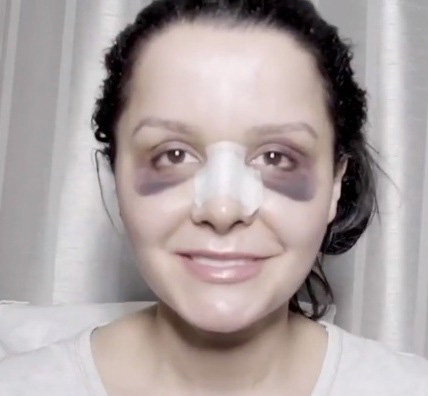 Maraisa passa por cirurgia plástica e aparece com olhos roxos nas redes sociais