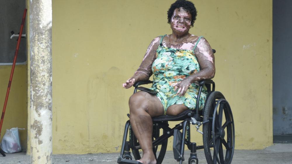 ‘Perdoei e continuei. Olha o resultado’, alerta diarista queimada pelo ex