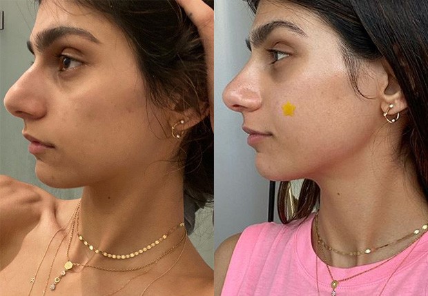 Mia Khalifa mostra resultado de cirurgia plástica no nariz: “Mais suave”