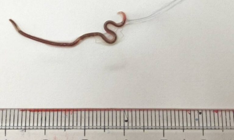 Após comer sashimi, japonesa é surpreendida com verme de 3,8 cm na garganta