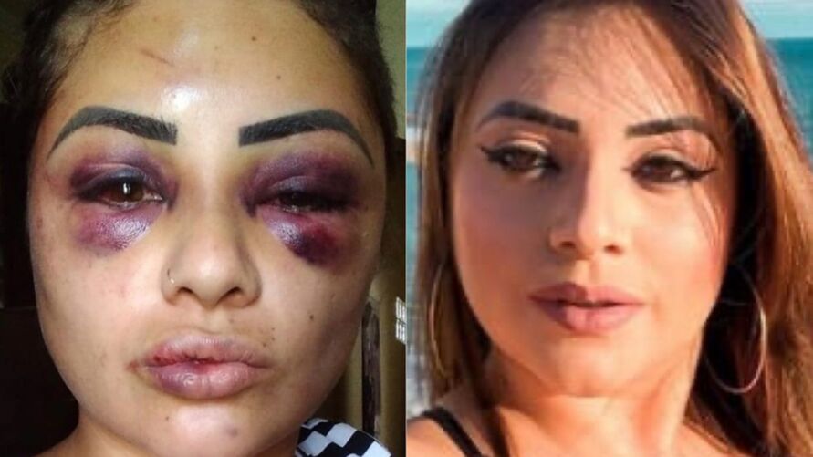 Blogueira é espancada e tem olhos quase arrancados por suposto envolvimento com homem casado