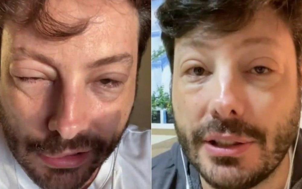Danilo Gentili surge com rosto desfigurado e diz: 'Quase fui pro saco'