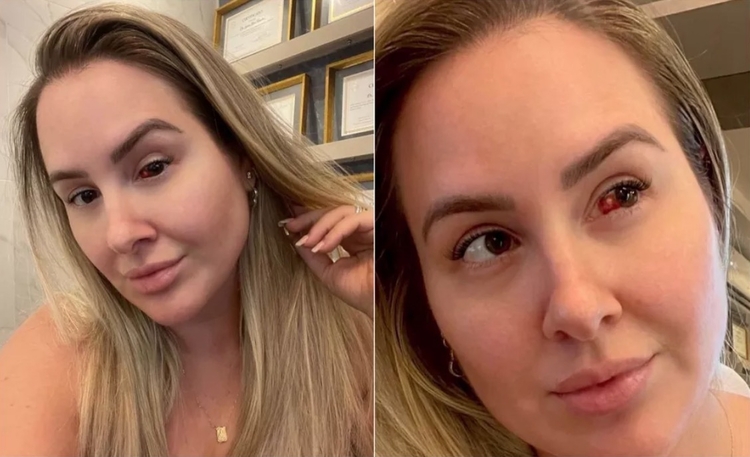 Ex-bbb Patrícia Leitte tem derrame ocular e mostra mancha de sangue no olho
