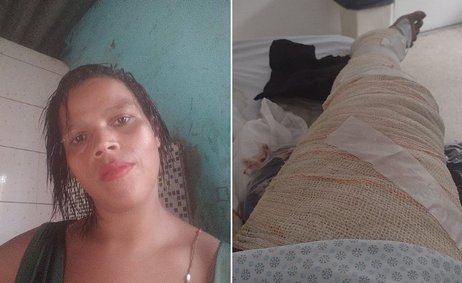 Sem dinheiro para gás, jovem morre queimada cozinhando com álcool; imagem forte