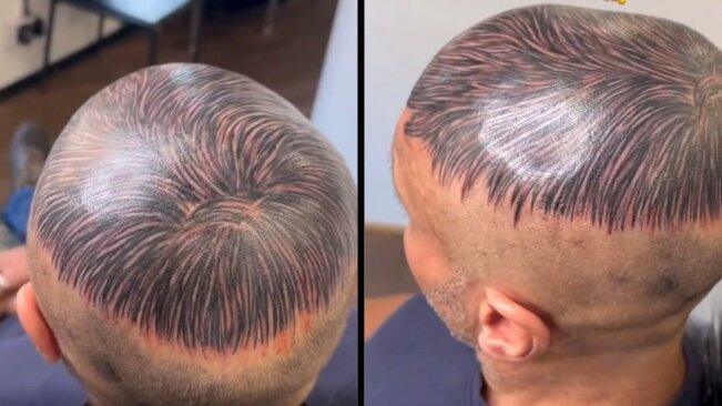 Homem desesperado por ser calvo faz tatuagem que simula cabelo e viraliza na internet