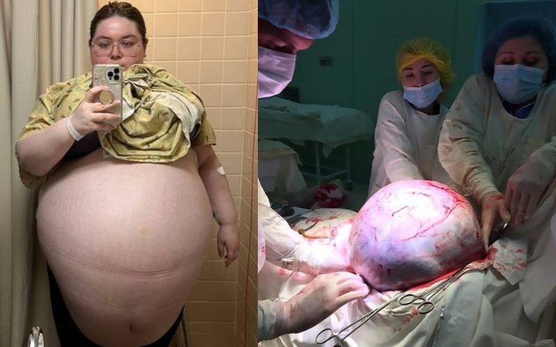 Mulher retira tumor gigante de 47 kg do ovário
